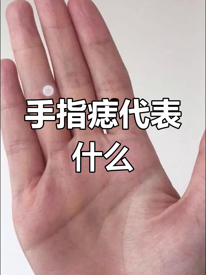 手指痣的含义解析