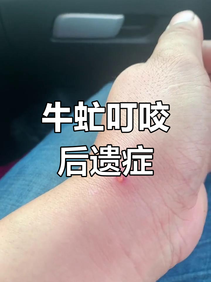 牛虻叮咬后,五天仍痒不止,伤口流水难忍