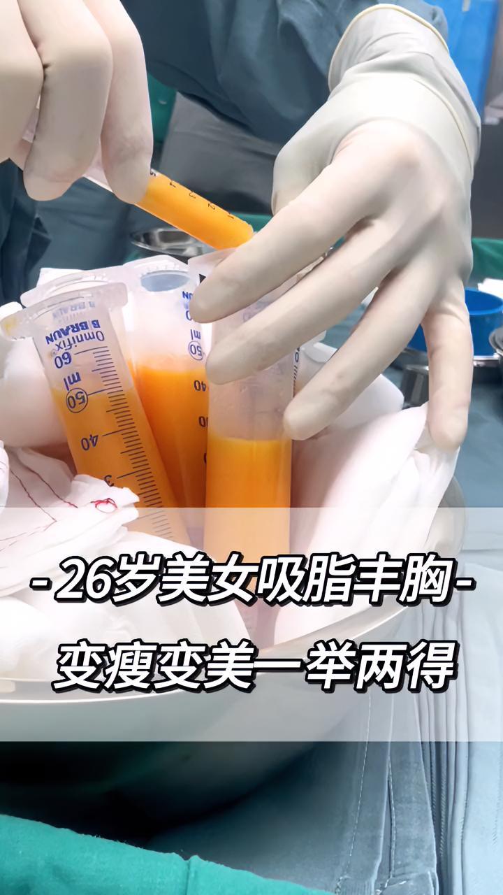 26岁美女吸脂丰胸,变瘦变美一举两得!