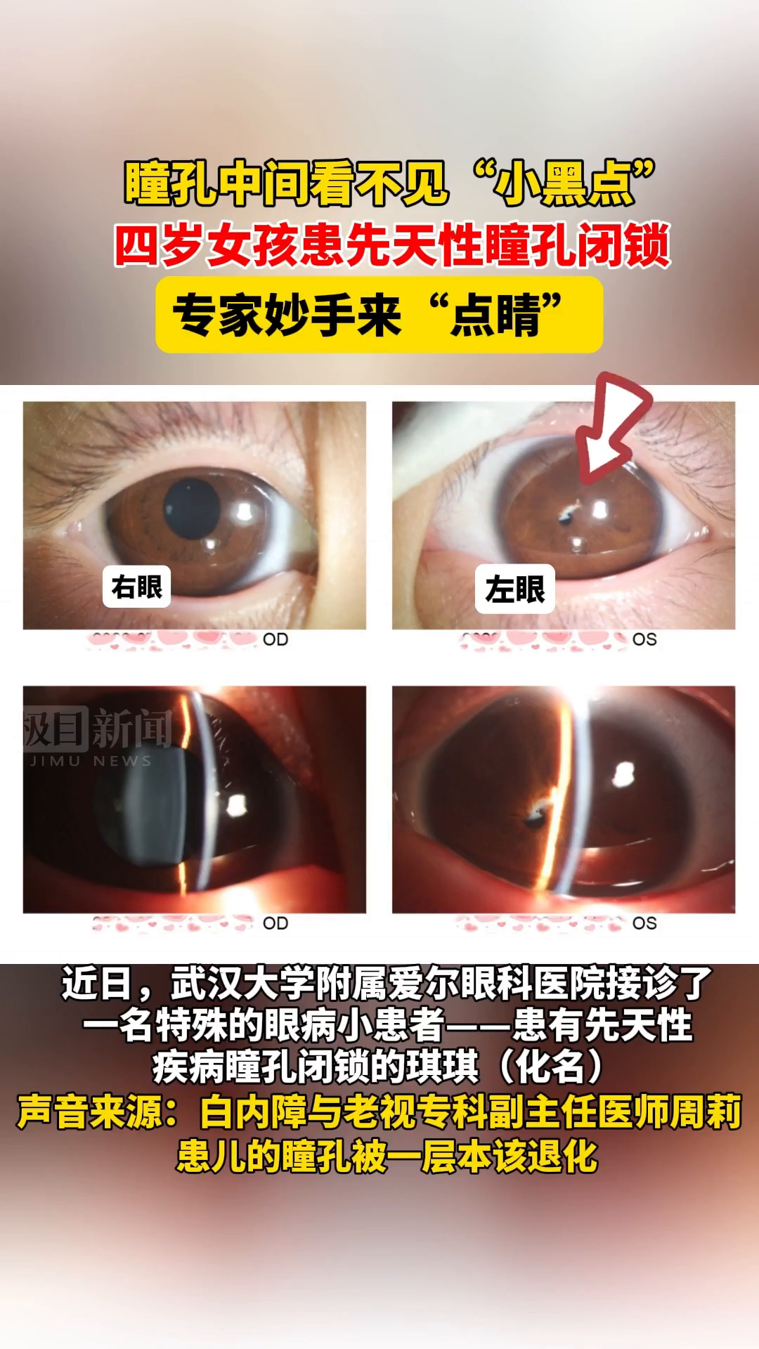 「视频」瞳孔中间看不见小黑点,四岁女童患先天性瞳孔闭锁,专家妙手来