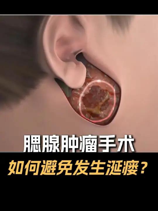 腮瘘是什么图片