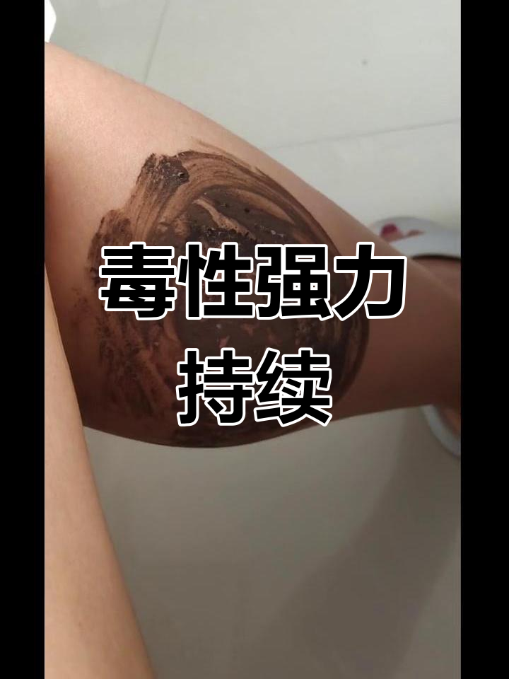 牛虻咬伤后皮肤变黑,毒性强烈,一周仍未恢复