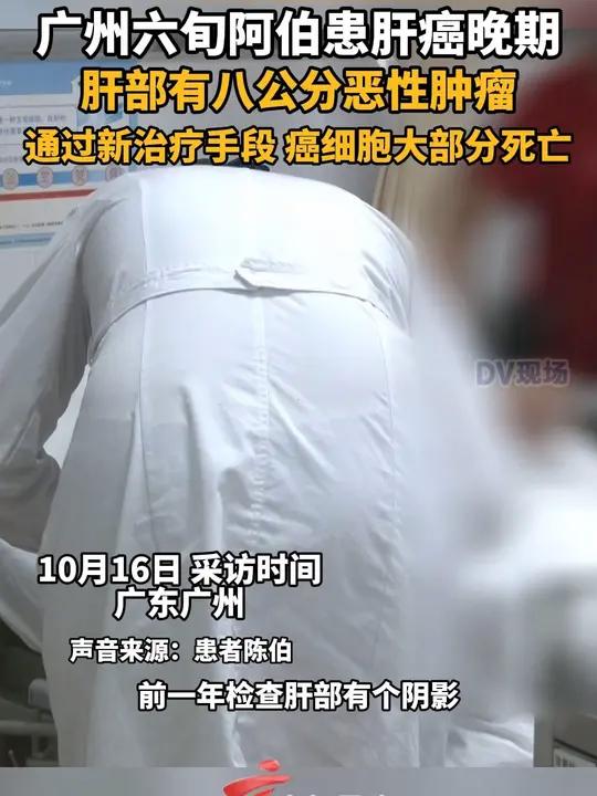 患肝癌晚期,肝部有八公分恶性肿瘤,通过新治疗手段,癌细胞大部分死亡