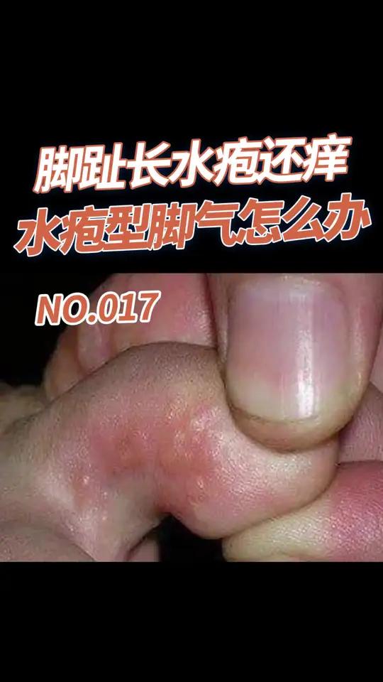 脚趾间长水疱,得了水疱型脚气怎么办