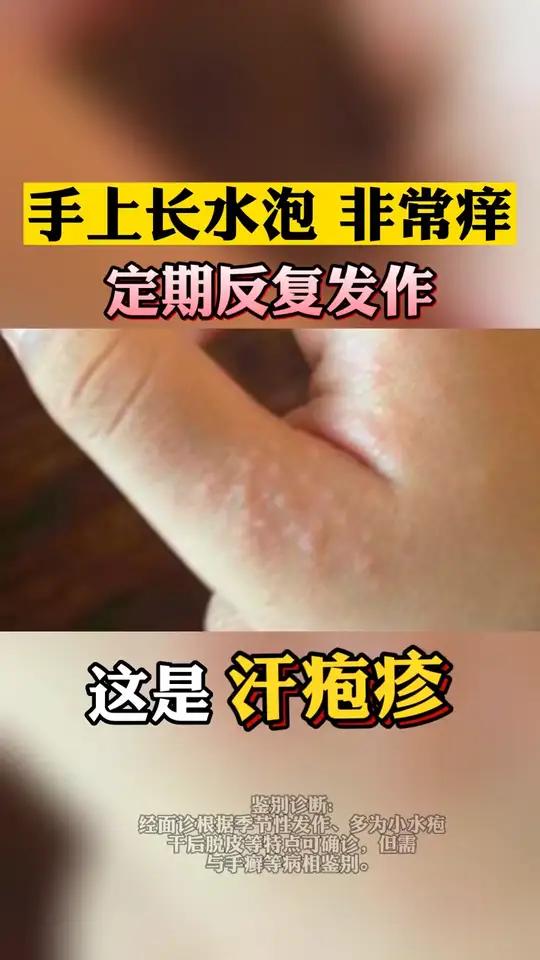 手上为什么会起小水泡