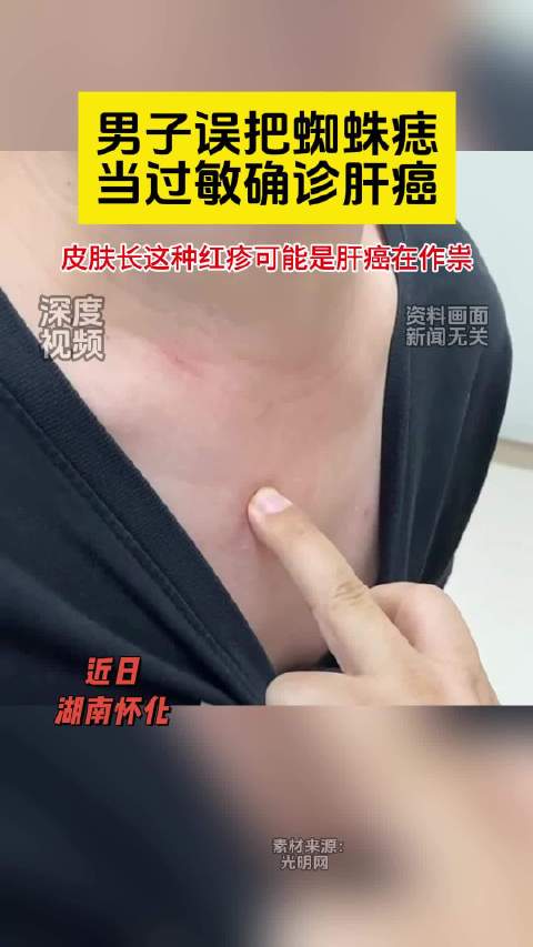 男子误把蜘蛛痣当过敏后确诊肝癌 近日,湖南怀化34岁