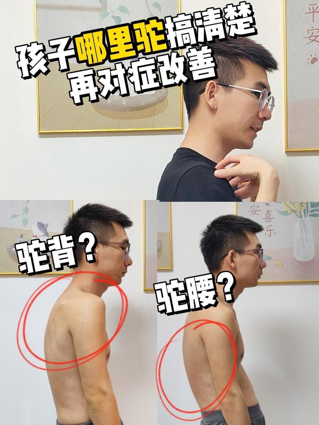 孩子哪里驼搞清楚 再对症改善 驼背 驼背矫正 驼腰 孩子驼背 体态纠正