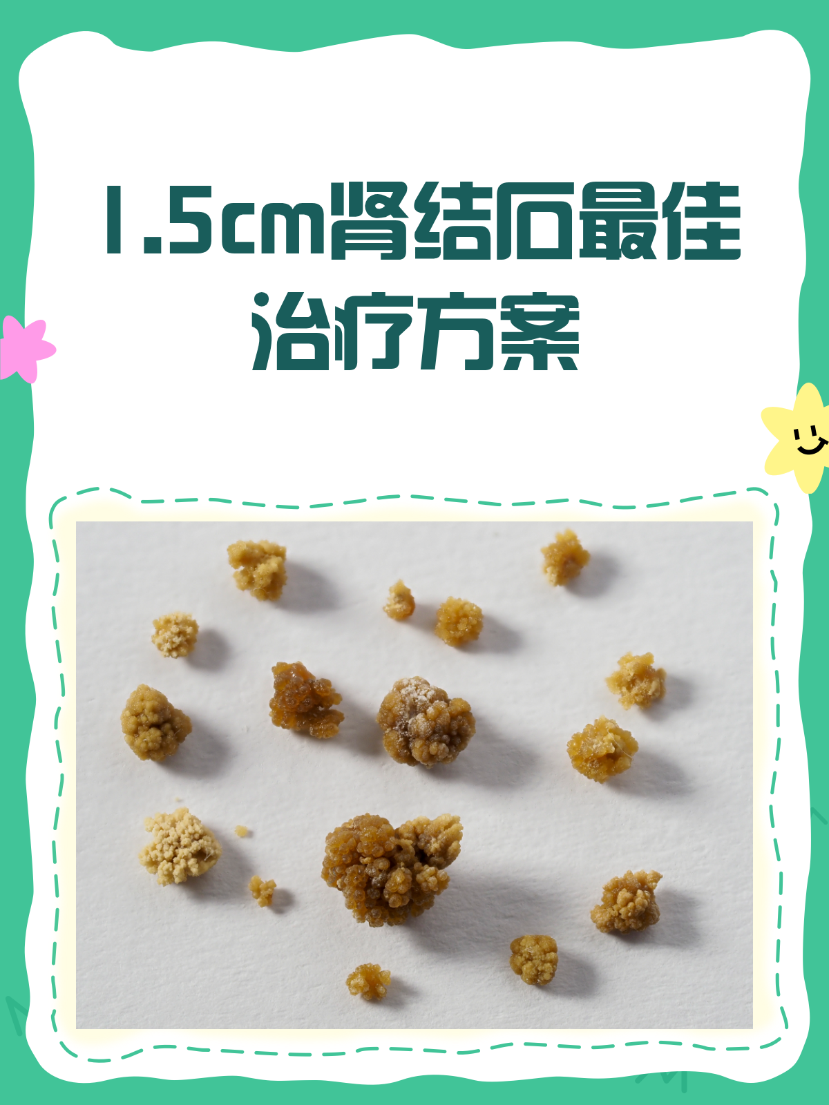 肾结石1.5cm?别急,治疗攻略来啦!