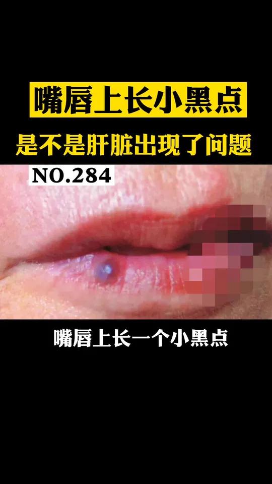 一些老人,嘴唇上长了一个小黑点,以为是肝脏出现了问题其实不是的