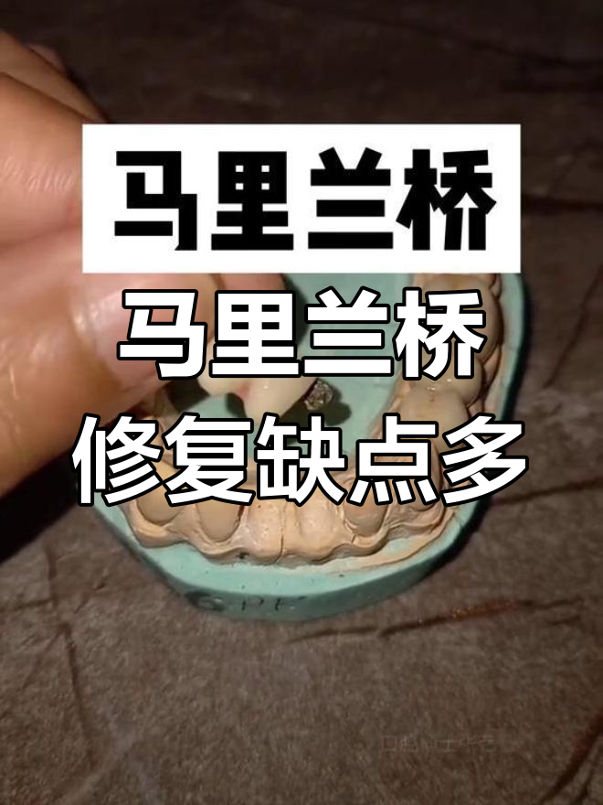 马里兰桥修复:前牙的替代方案,但已较少使用