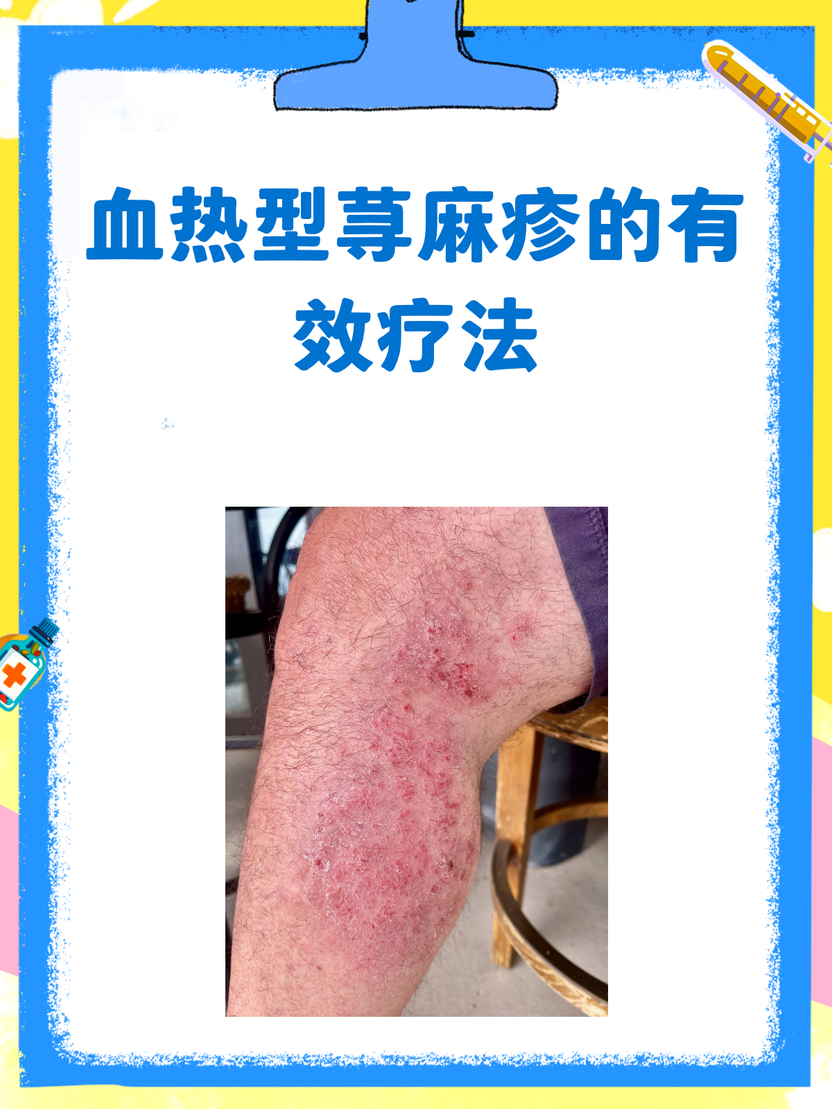 血热型荨麻疹怎么办?有效治疗方法大揭秘!