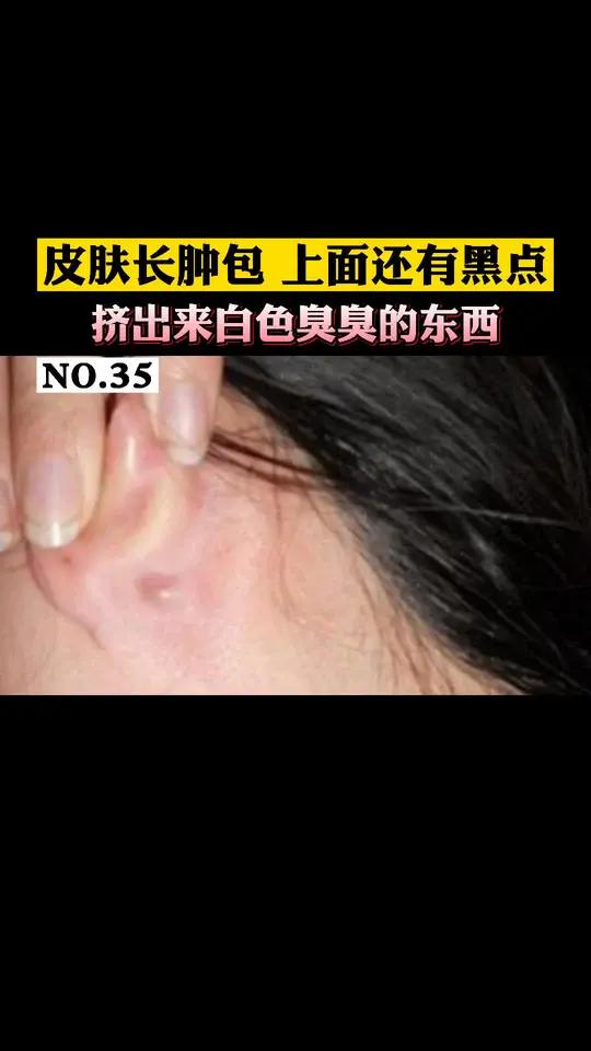 还有黑色的小开口,能挤出白色的东西非常臭,这可能就是皮脂腺囊肿该