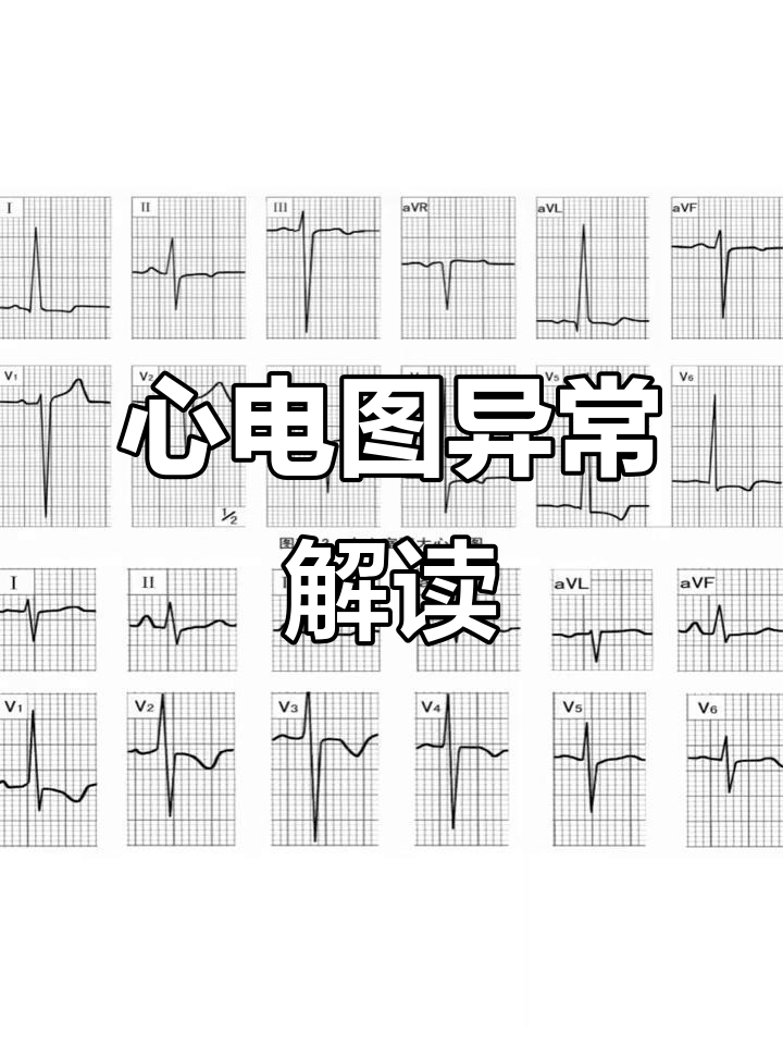常见异常心电图诊断技巧解析