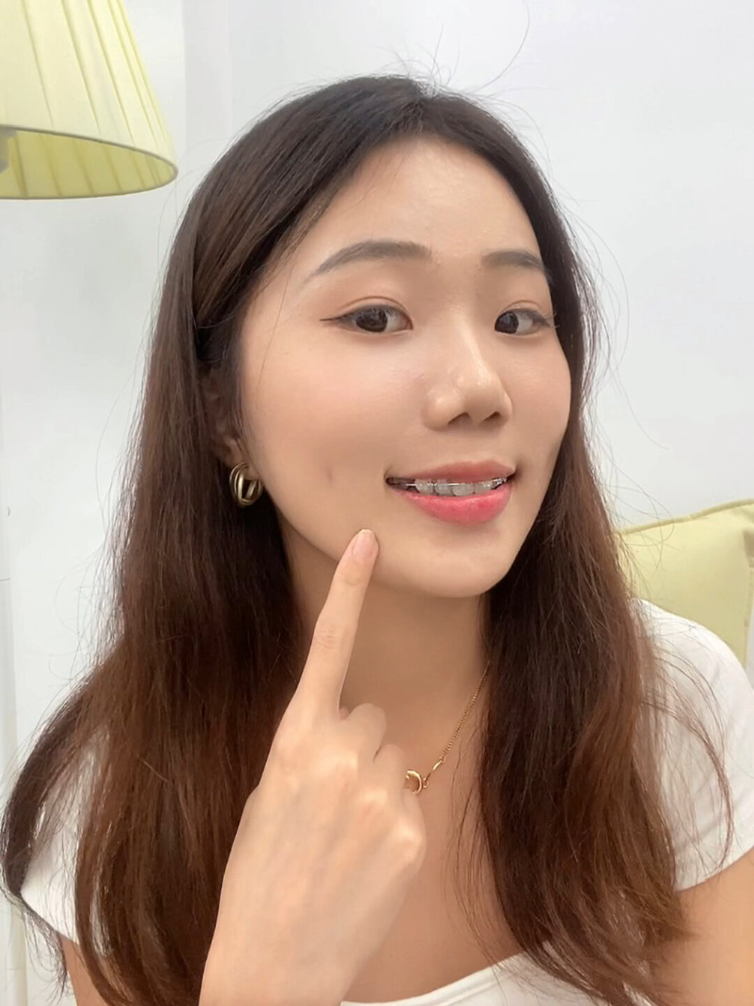戴陶瓷牙套一年后的变化后悔没早点戴