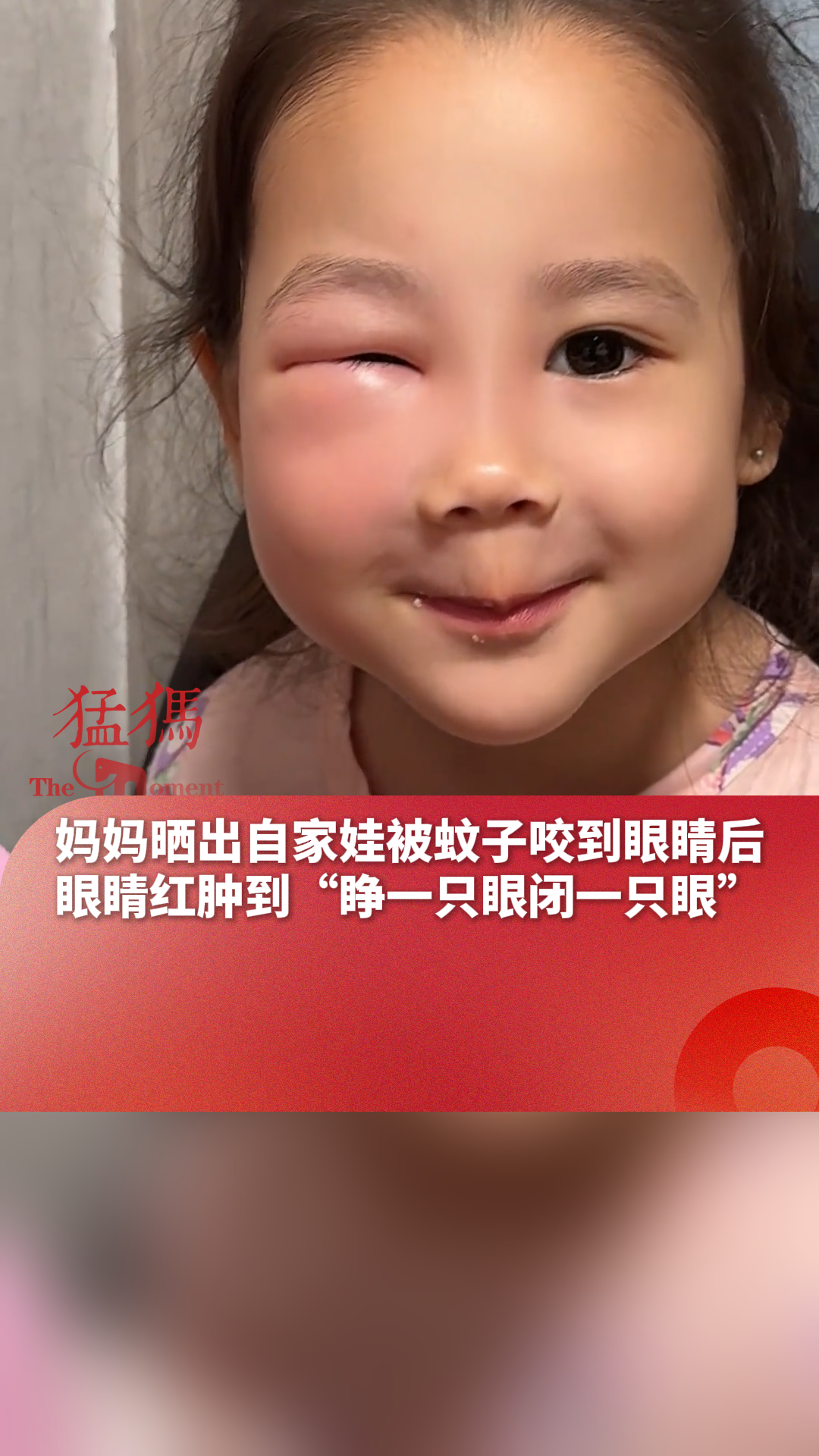 妈妈晒出自家娃被蚊子咬到眼睛,红肿到"睁一只眼闭一只眼"