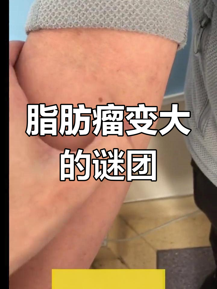 为什么身上会长脂肪瘤