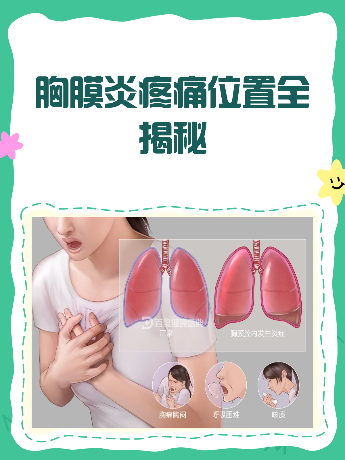 胸膜炎疼痛位置大揭秘!你中招了吗?