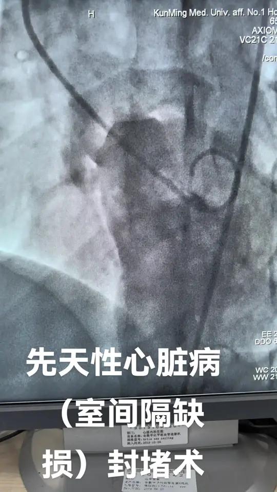 先天心脏为什么20几岁才发现 先天心脏为什么20几岁才发现