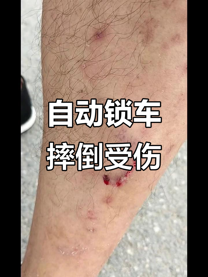 哈啰单车骑行中自动锁车,摔伤后无人理睬