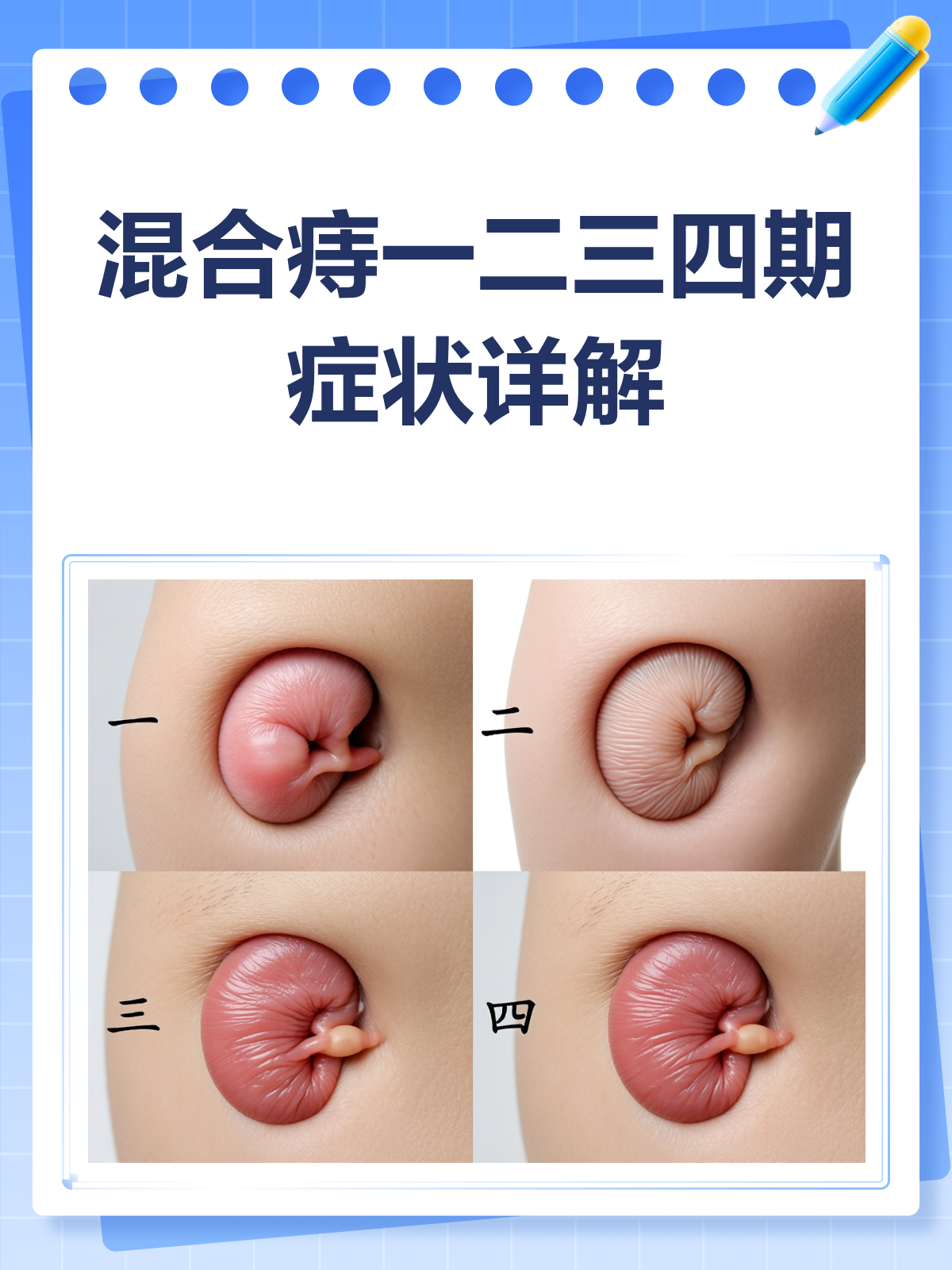 混合痔分期全解析!你是哪一期?