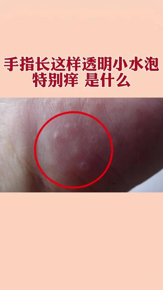 手上为什么会有小水泡一会儿就消失了为什么在线