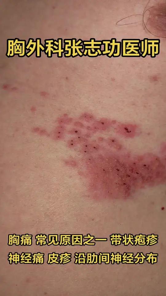胸痛 常见原因之一:带状疱疹,神经痛,皮疹,沿肋间神经分布 胸痛常见