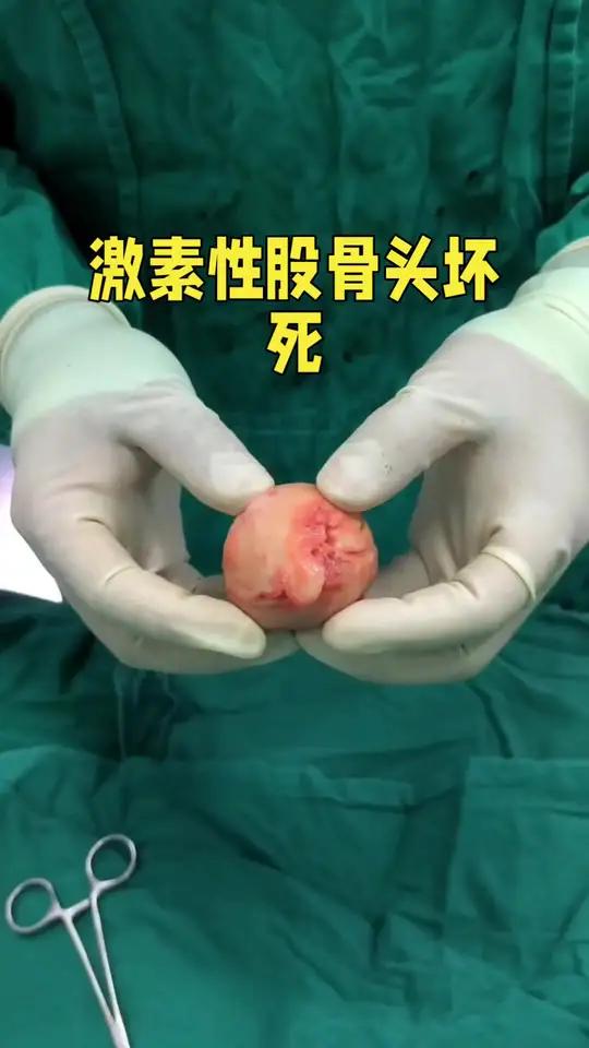 激素性股骨头坏死 激素性股骨头坏死是因长期或大量使用糖皮质激素