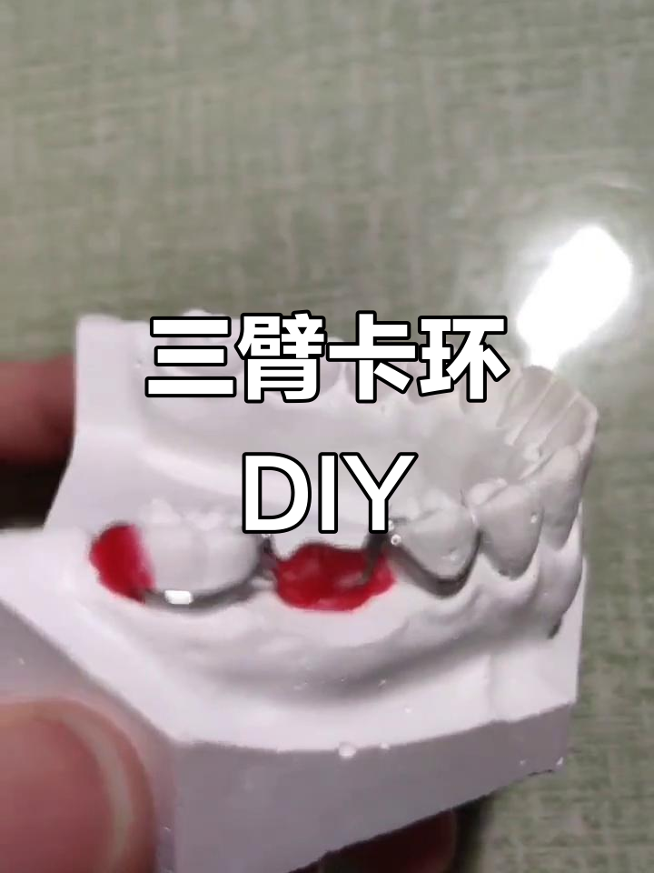 牙医日常:亲手制作三臂卡环模型,挑战口腔技艺