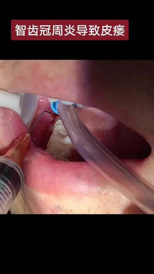 不处理牙齿用啥药都没用.牙齿炎症不要拖,越拖越严重
