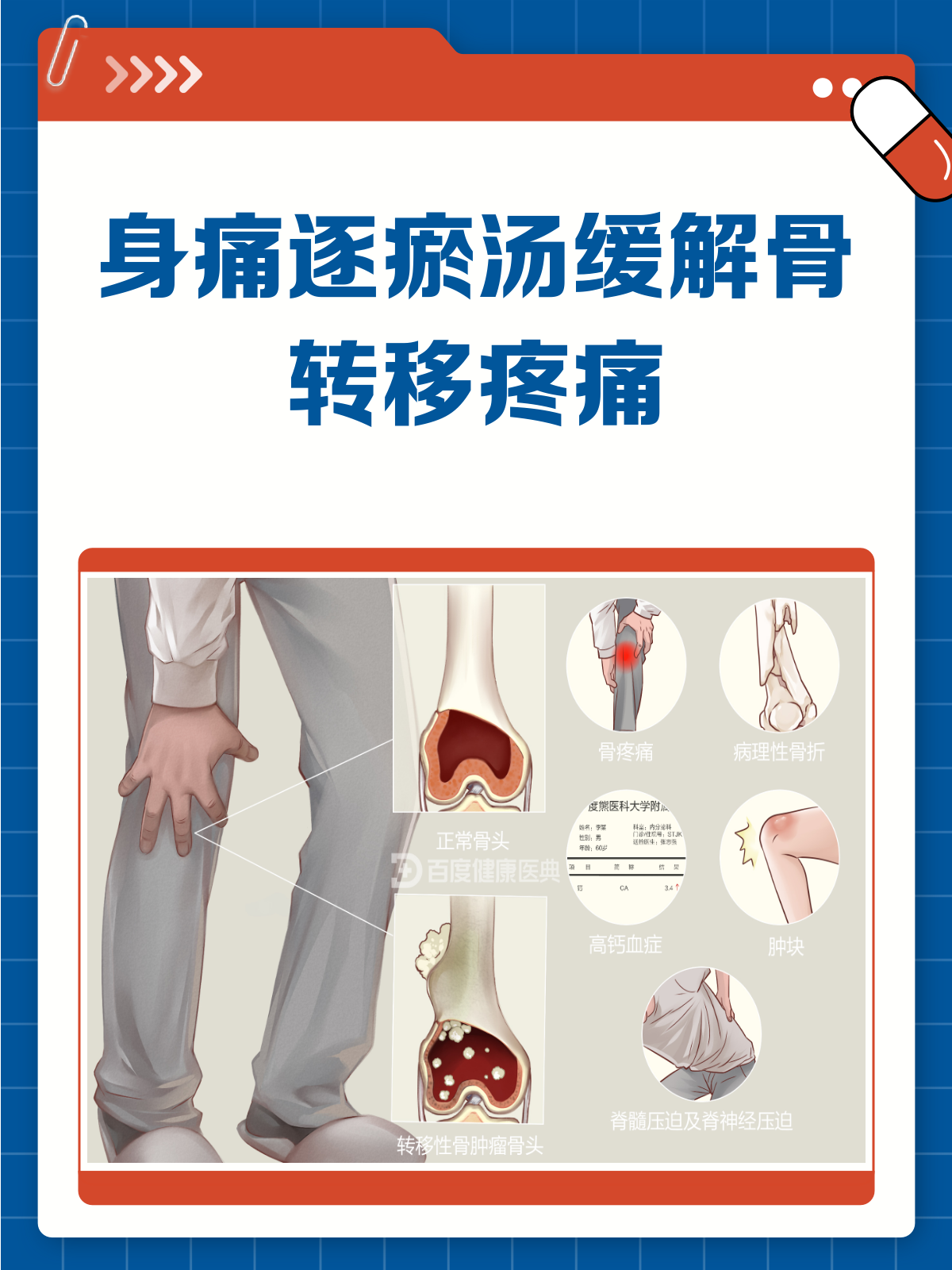骨转移疼痛怎么办?身痛逐瘀汤来帮忙!