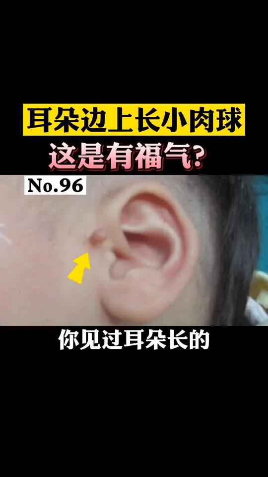 你有见过耳朵边这种小肉球吗?附耳有些老人说是有福气的表现