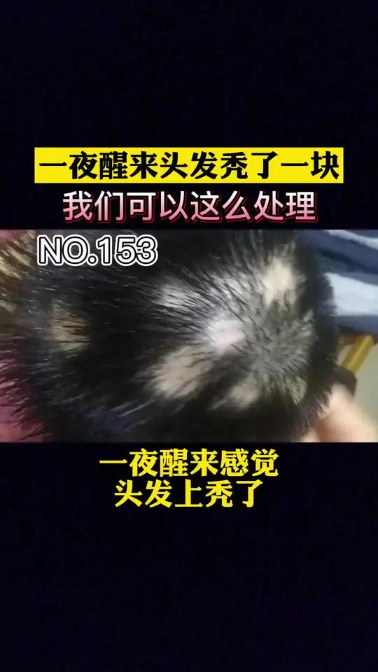 为什么头发会突然秃了一块可以长出来头发么为什么在线 为什么头发会突然秃了一块可以长出来头发么为什么在线