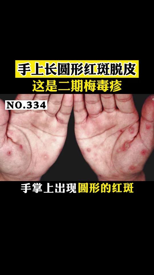 上出现圆形红斑脱皮,不痛不痒的,你以为这是癣,但这其实是 二期梅毒