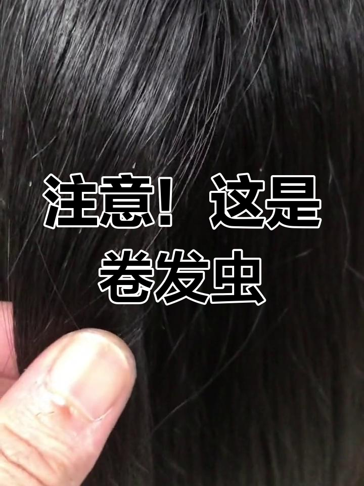 头皮上的白色小颗粒,竟是卷发虫