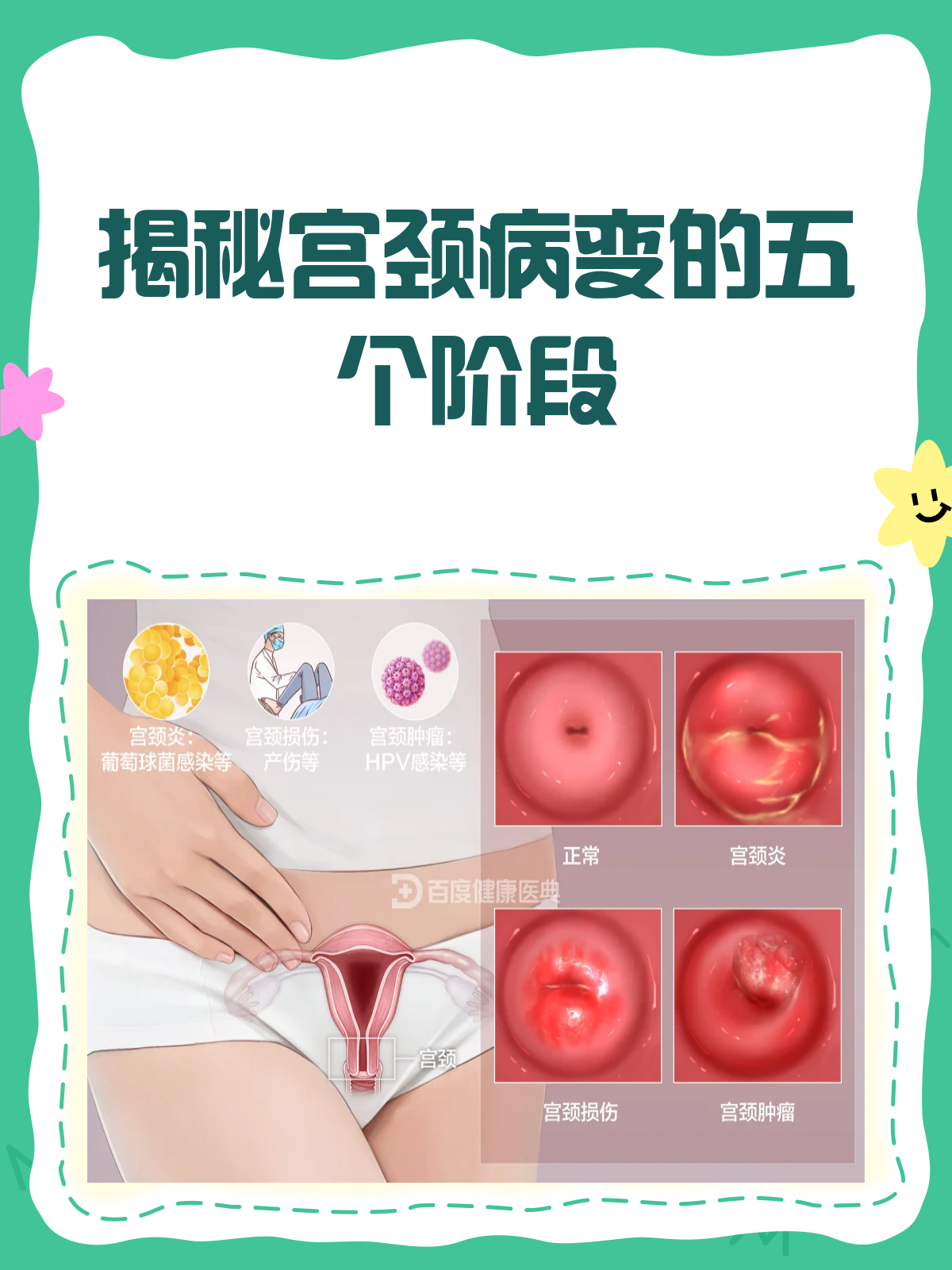 宫颈病变,真的有五个阶段吗?