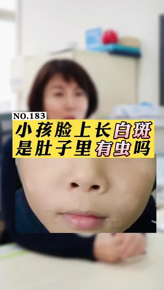 小孩子脸上的小白斑片,这可不是肚子有虫,别乱给孩子吃打虫药了