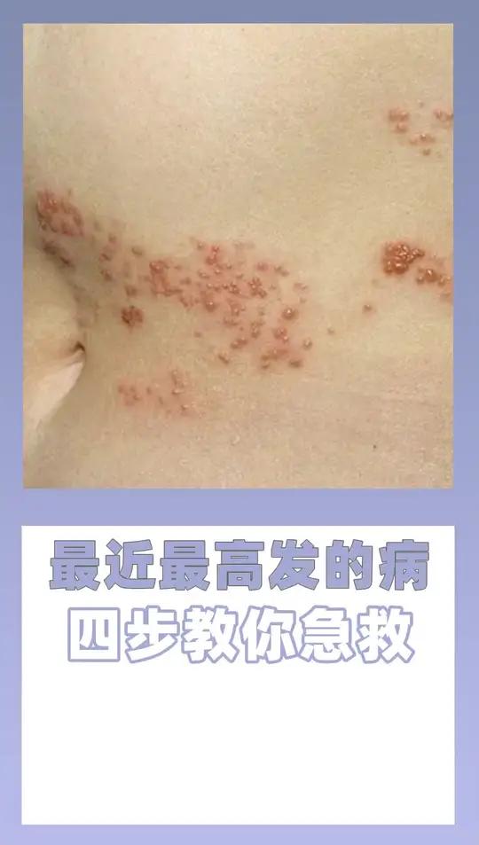 最近最高发的病之一蛇缠腰教你四步处理
