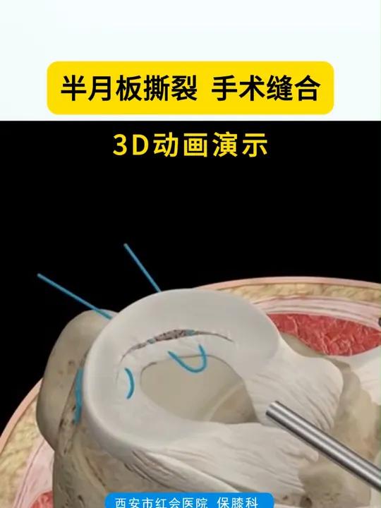 膝关节半月板撕裂,手术缝合3d动画演示