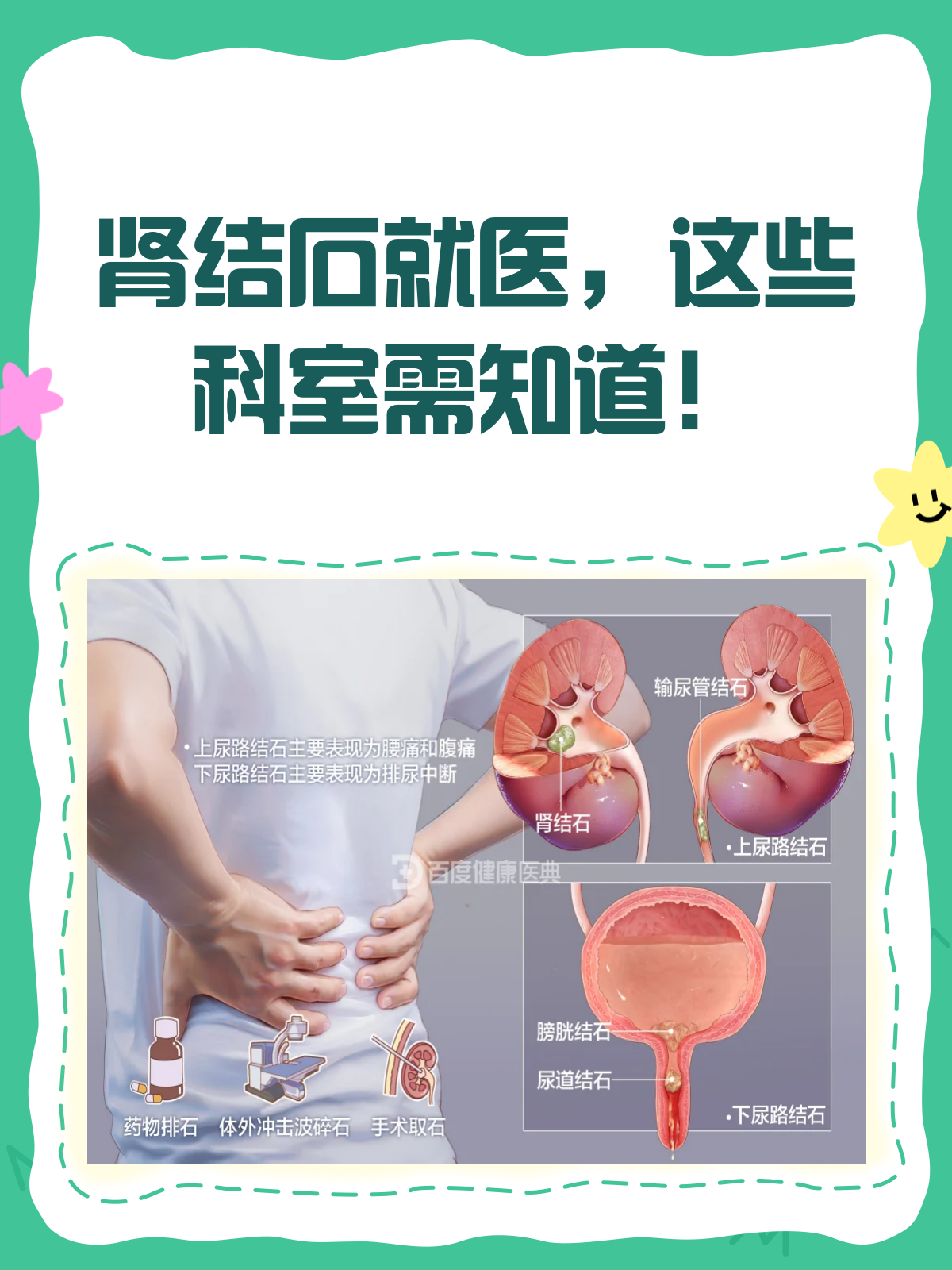 肾结石犯了去医院,到底该挂哪个科?