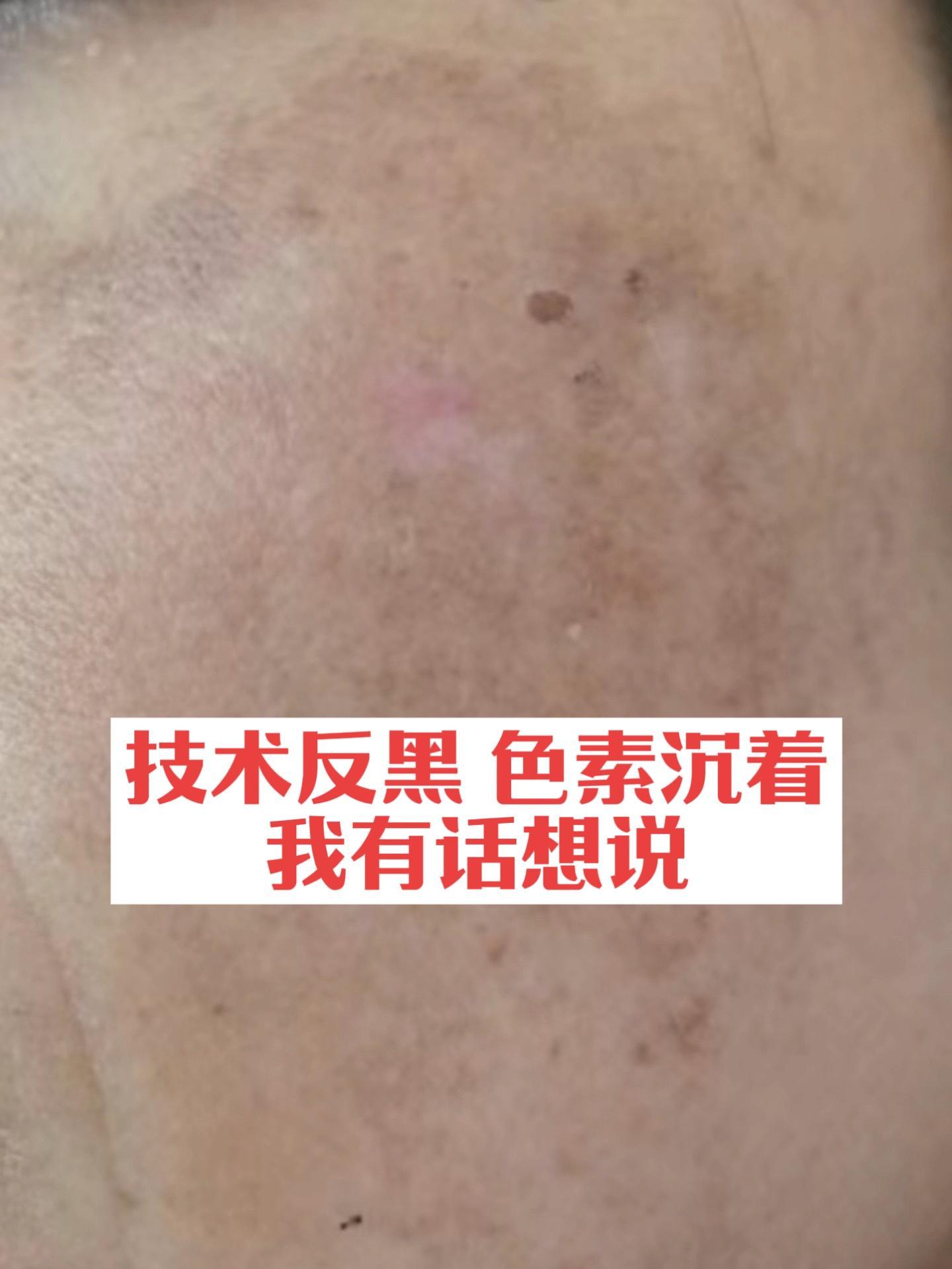 办淡斑变美过程分享她们说这个方法很给力 技术后色斑变严重了怎么办