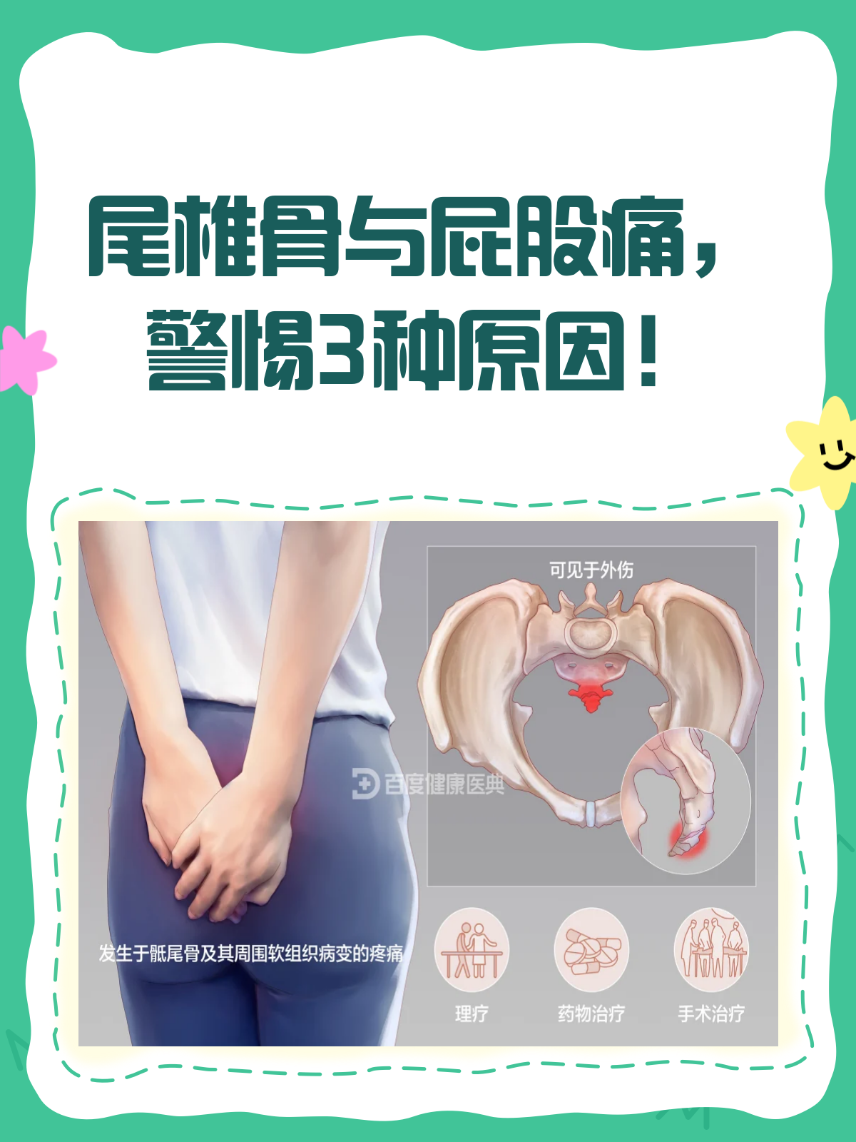 尾椎骨痛连带屁股痛?一文教你如何应对!