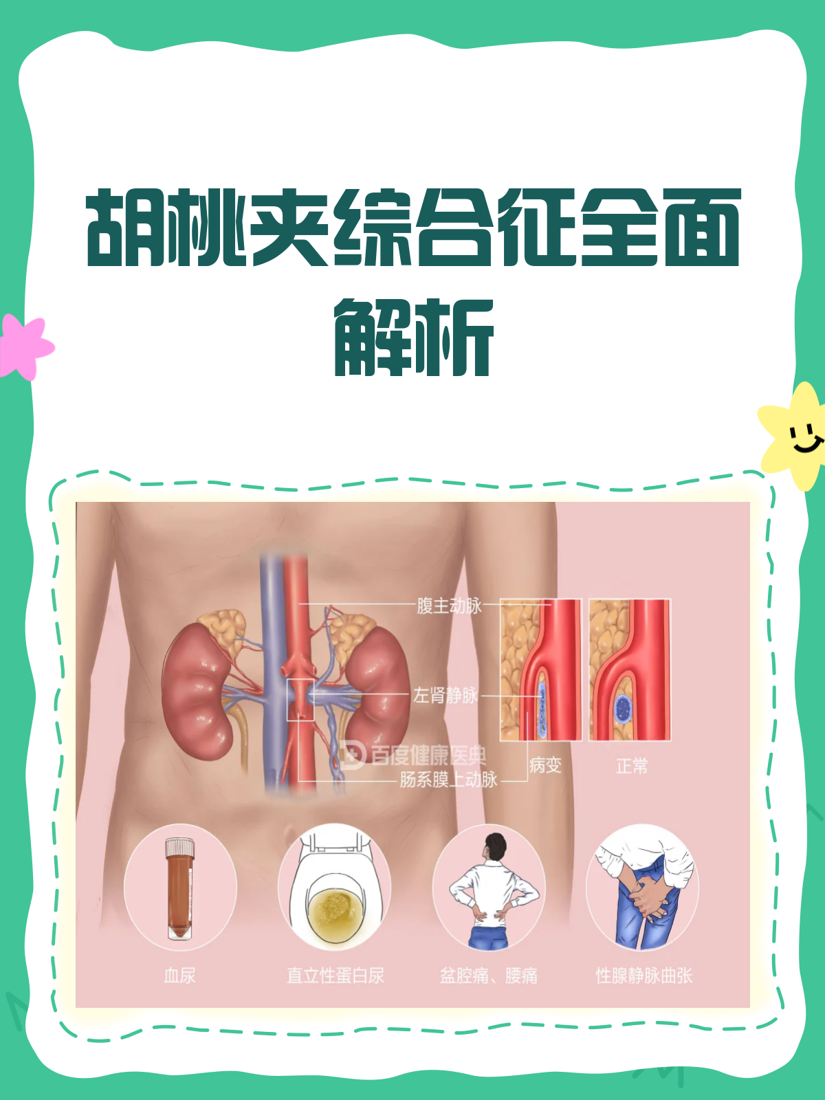 胡桃夹综合征?揭秘这个"夹"出来的病!