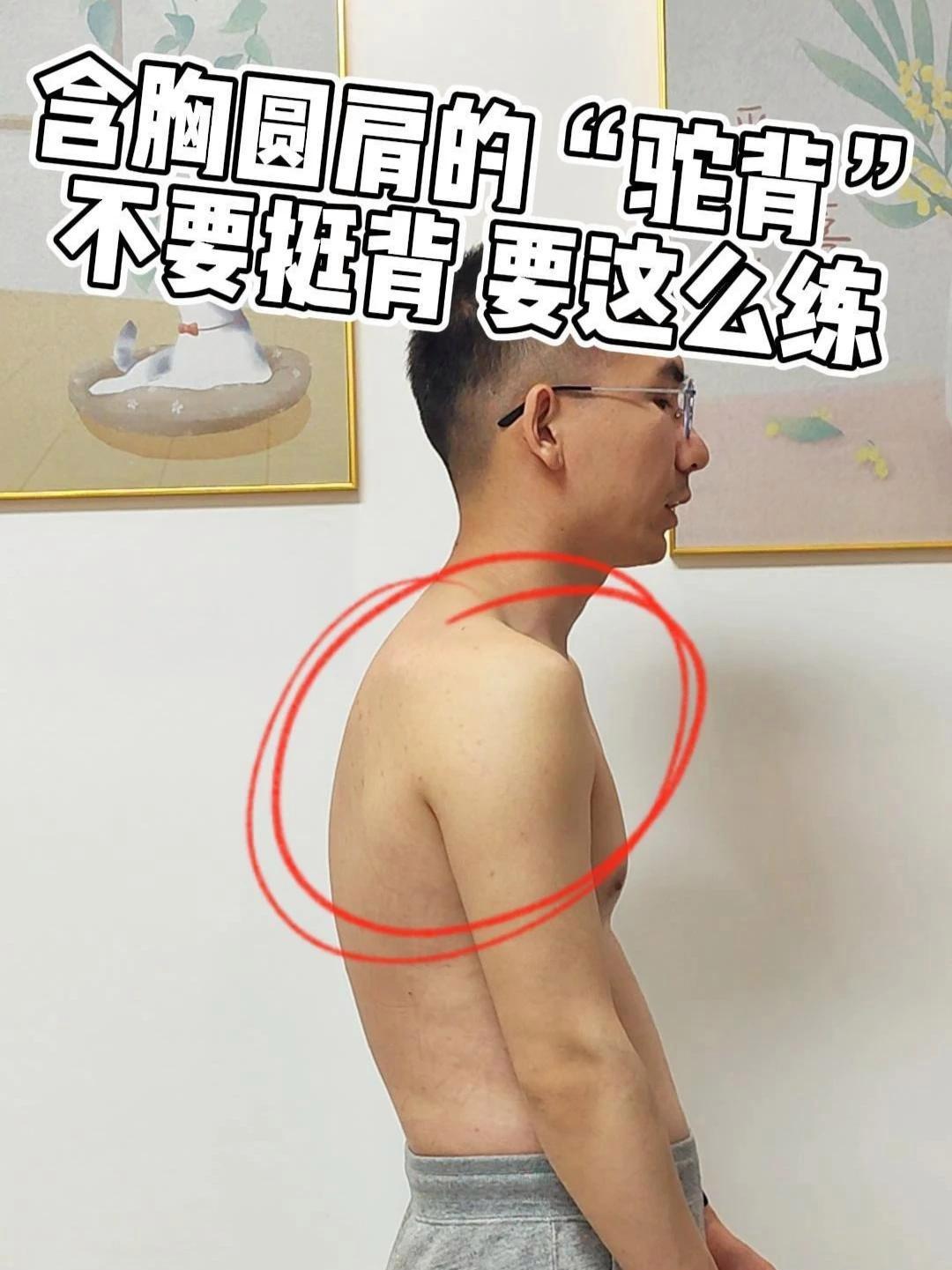 含胸圆肩的"驼背" 不要挺背 要这么练 含胸驼背 圆肩 圆肩驼背 圆肩