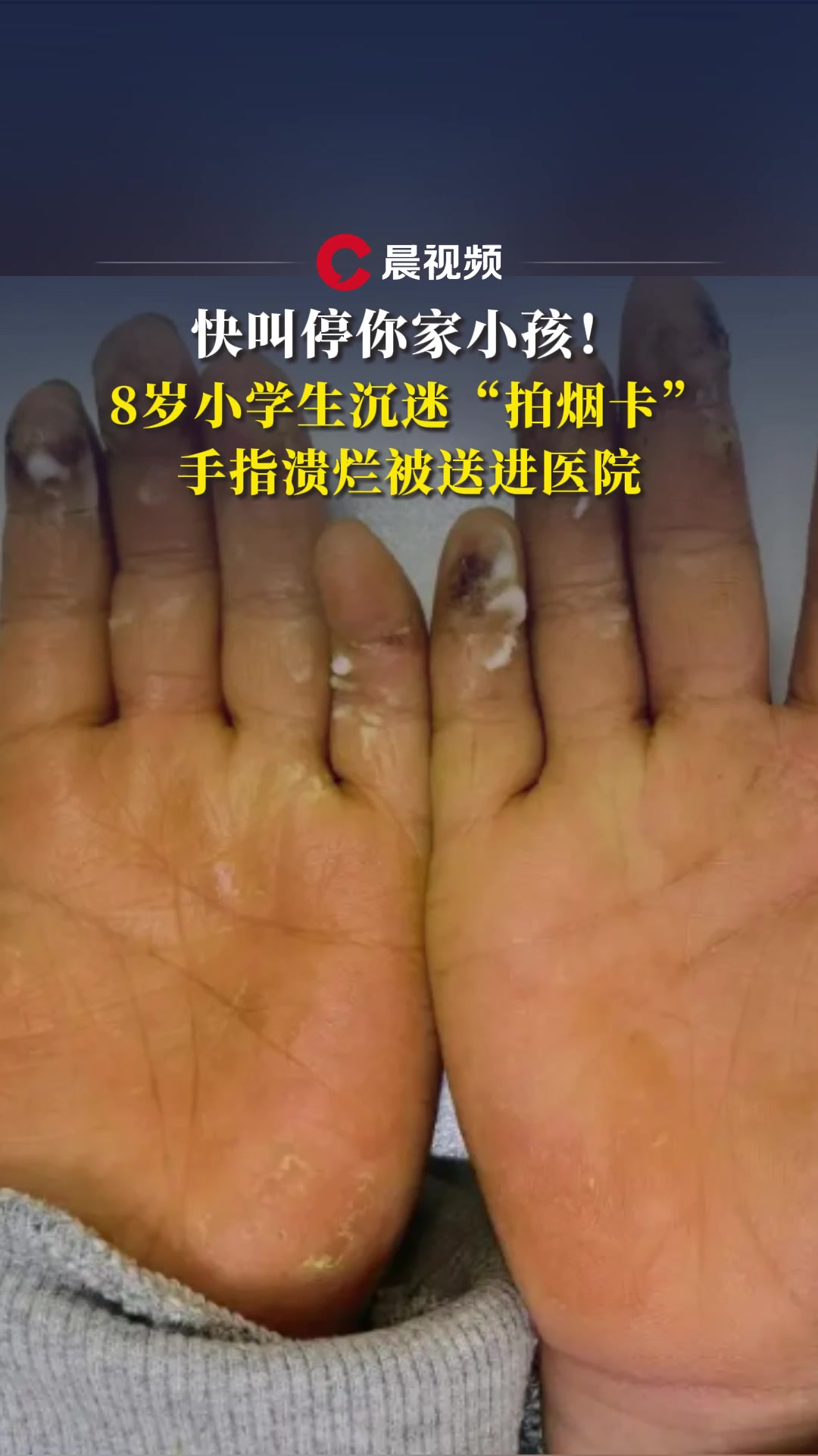 快叫停你家小孩!8岁小学生沉迷"拍烟卡",手指溃烂被送进医院