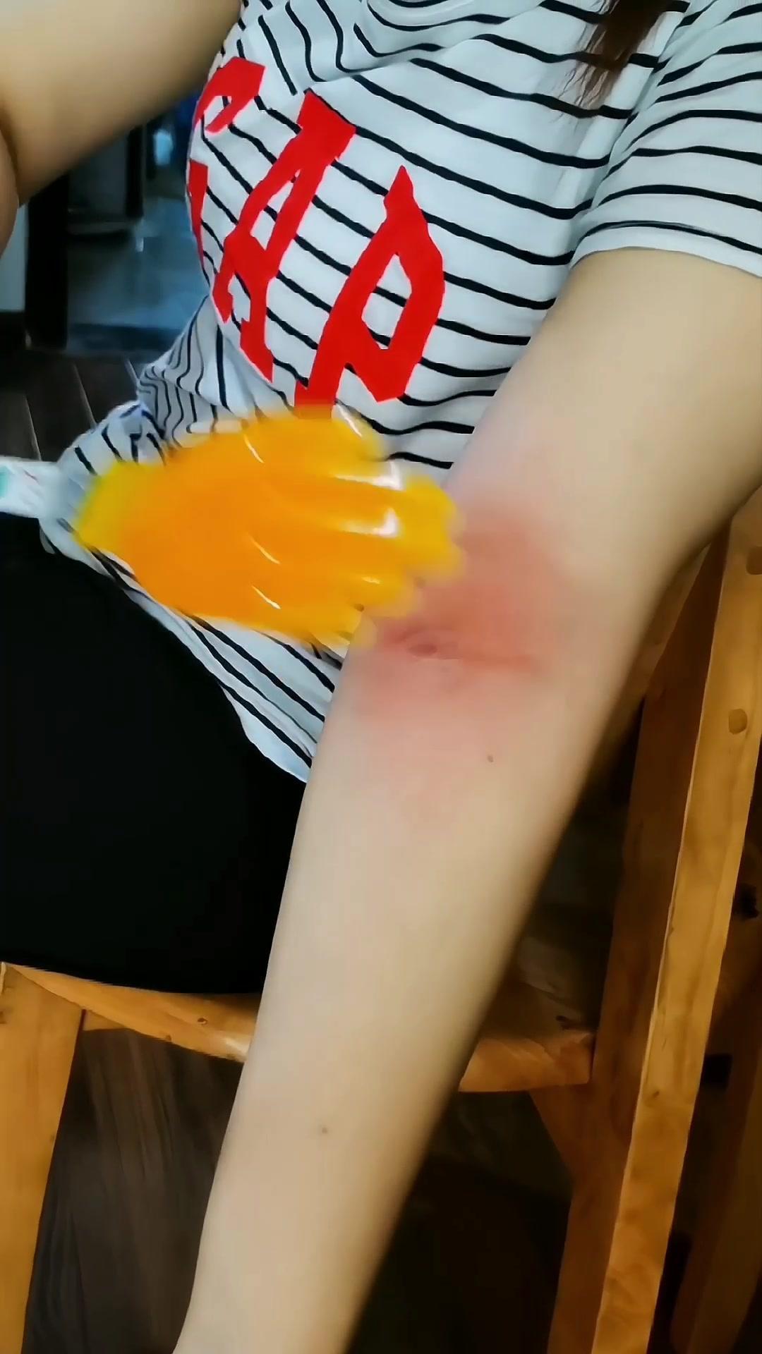 买的小黄手拍痧板收到一段时间了,自己对自己下手挺狠,视频里的我出痧