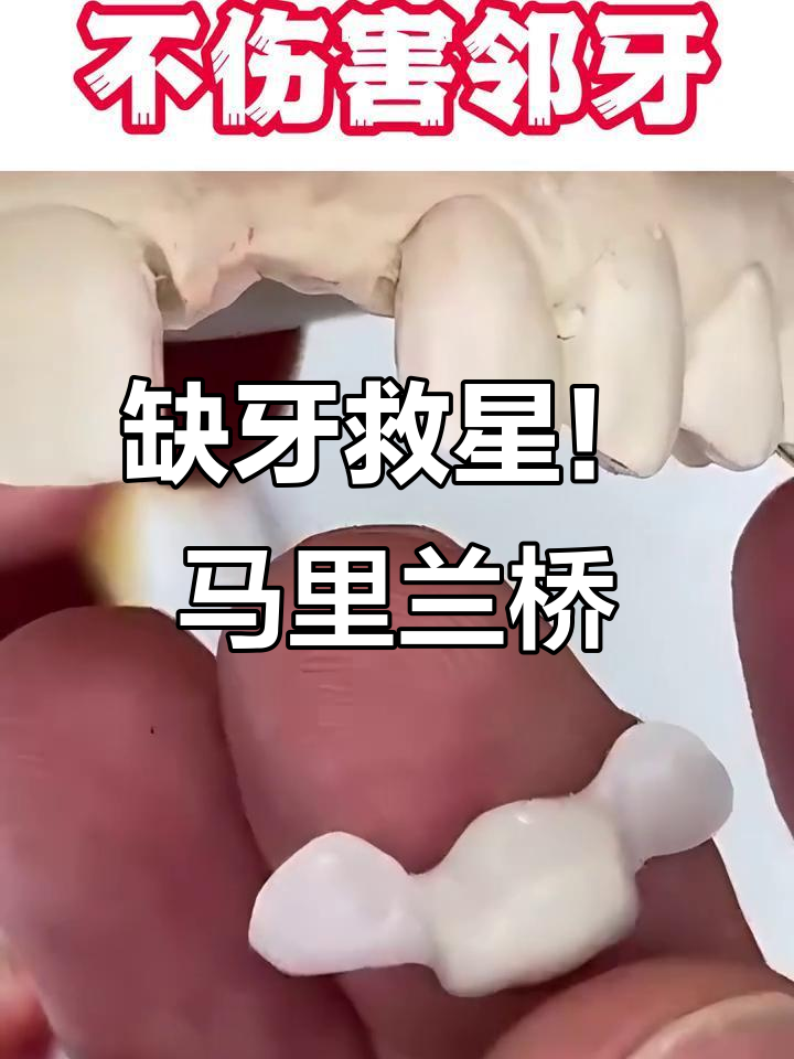 马里兰桥修复术:牙齿缺失的完美解决方案