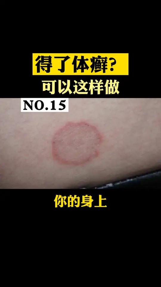 身上出现环形红斑,表面还有小小的鳞屑,非常痒!这可能是体癣