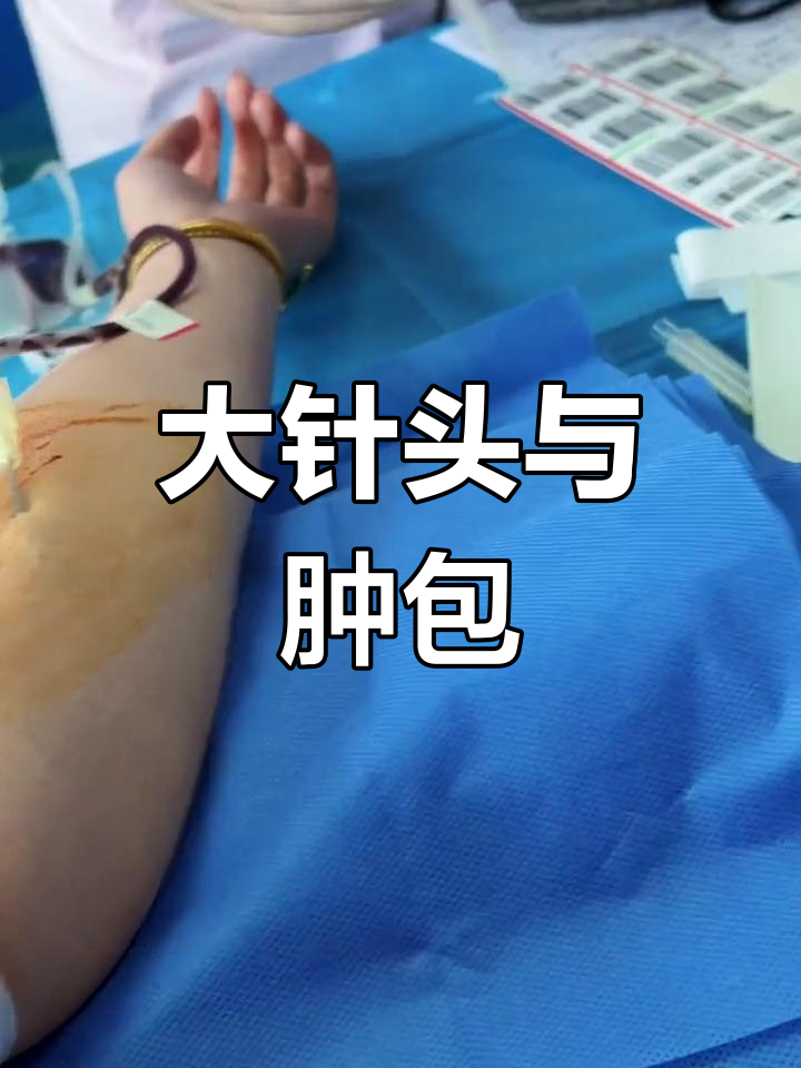 献血针头超大,鹌鹑蛋般的肿包让人心惊!