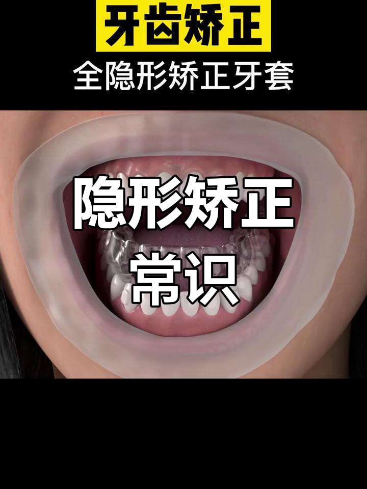 全隐形矫正牙套,轻松解决牙齿问题