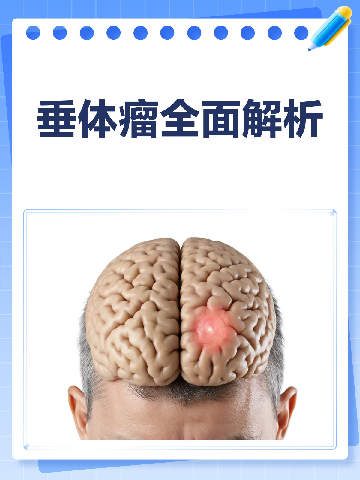 垂体瘤揭秘!脑袋里的"不速之客"